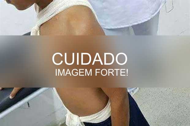 Menino que teve coração atravessado por espeto foi salvo por milagre, dizem  médicas, Pernambuco